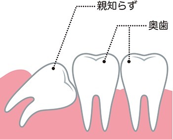 親知らずの治療（抜歯）